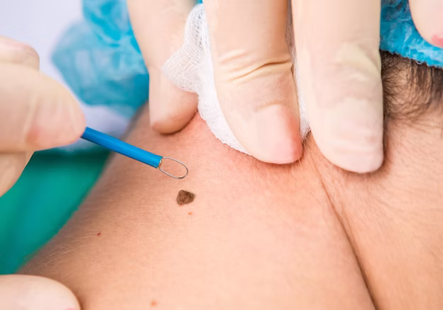 skin-lesion-removal-options skin-lesion-removal-options